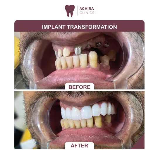 A successful case with one patiant came to our clinic for tooth implant