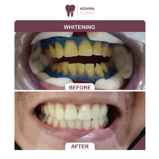 Case showos whitening where our patiant had yellow teeth and after whitening the teeth looks perfect