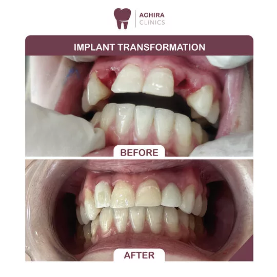 Teeth implant case at our dental practice in Deira Al Rigga Street