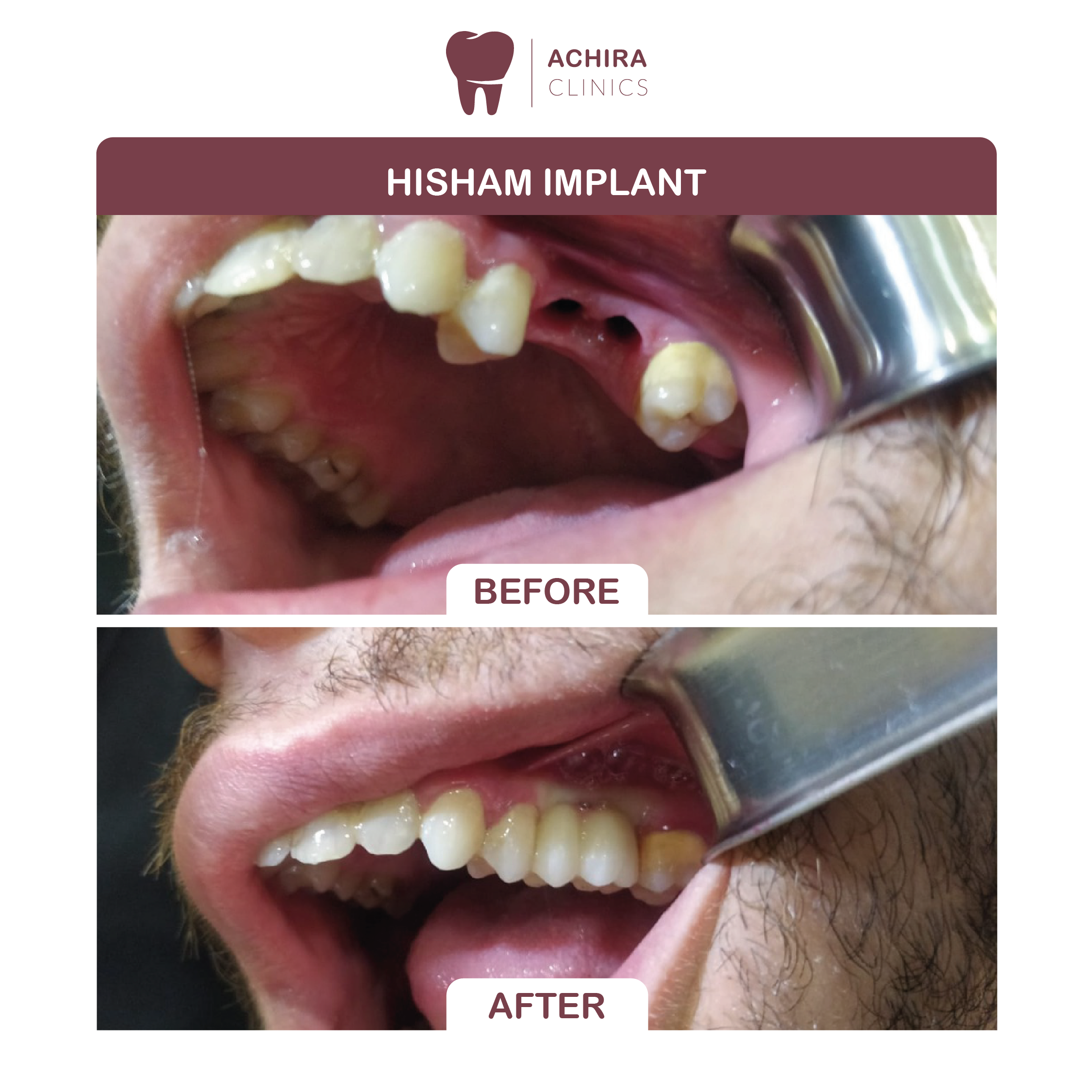 Hisham Implant 01